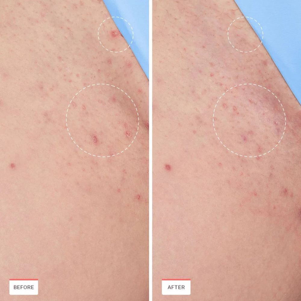 Smoothing Solution Ingrown Hair Treatment