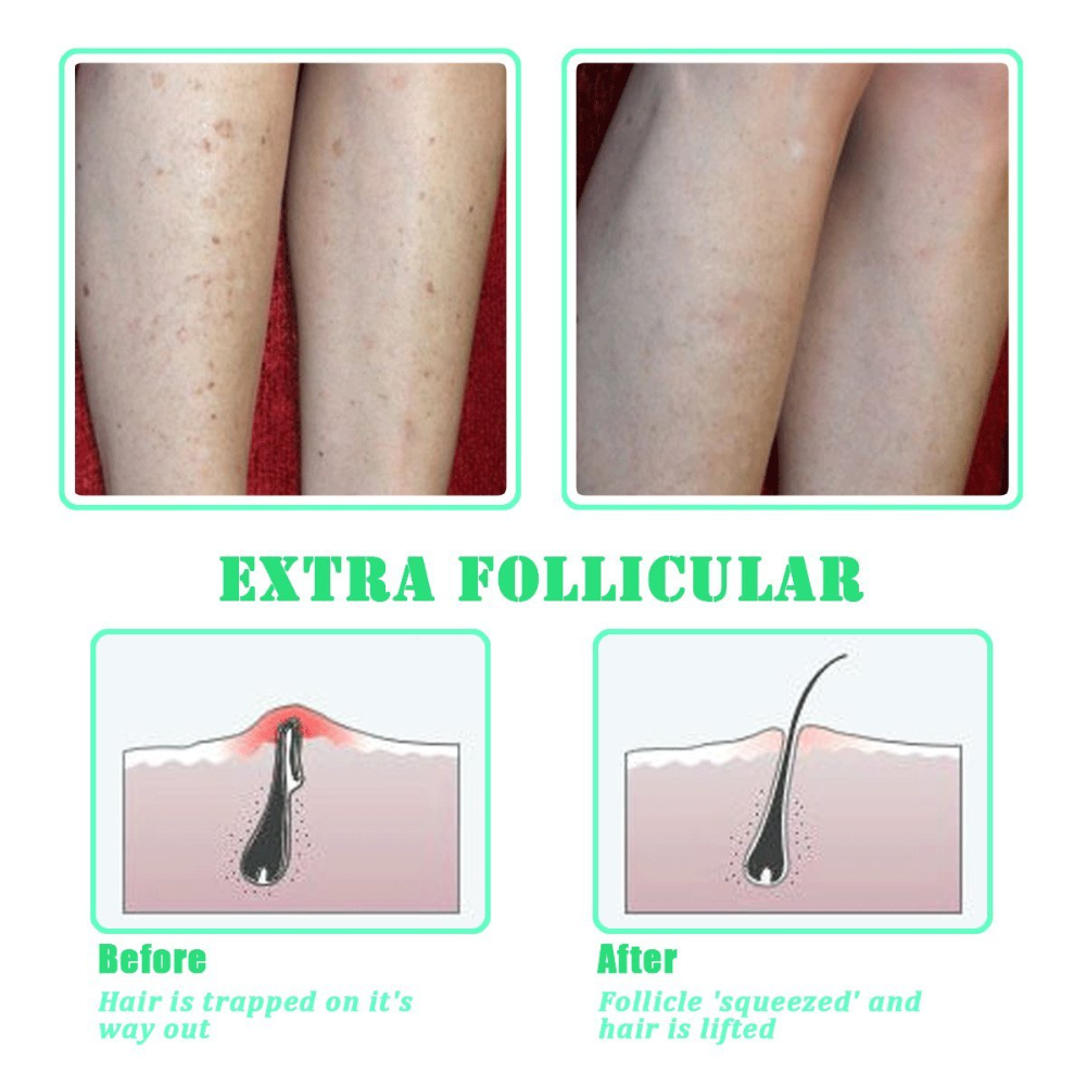 Exfoliating Brush for Ingrown Hair Treatment