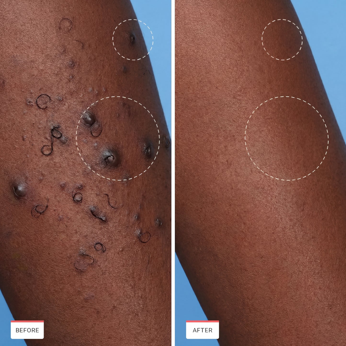 Ingrown Hair Treatment — #1 Ingrown Hair Solution Built for Black Skin