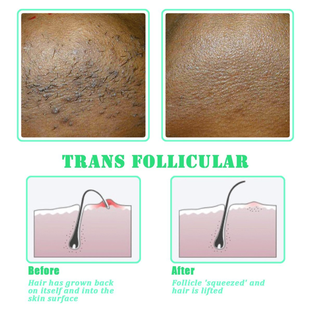 Exfoliating Brush for Ingrown Hair Treatment