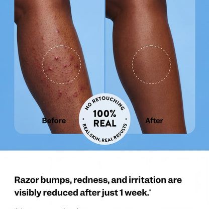 Ingrown Hair Treatment — #1 Ingrown Hair Solution Built for Black Skin