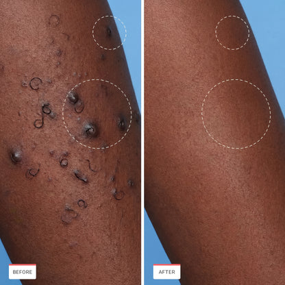 Ingrown Hair Treatment — #1 Ingrown Hair Solution Built for Black Skin