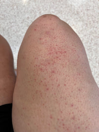 Irritation & Redness